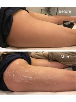 サロン ルイス アディクト(salon Lewis Addict)/BODYスタンプ◆痩身リバウドレス