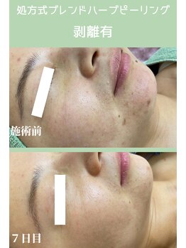 ハーシークレット(Her secret)/ブレンドハーブピーリング７日目