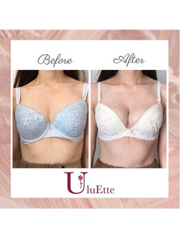ウルエッテ(UluEtte)/CカップからFカップへ/福岡豊胸