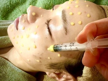 ルミエールフォートサイド(L’MIERE fortside)の写真/【たるみ毛穴/開き毛穴/ハリ改善】吸引×レチノールケアでふっくらハリ肌へ◎