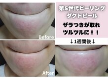 オアナヨーク(oana yoak)/韓国最新肌管理ピーリング♪