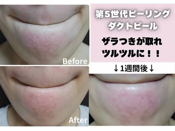 オアナヨーク(oana yoak)/韓国最新肌管理ピーリング♪