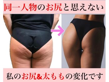 マール(Mar)の写真/【阿佐ヶ谷・南阿佐ヶ谷】本気で変わりたい大人の女性必見！強圧リンパ×最新マシーンで美脚・美尻になる！