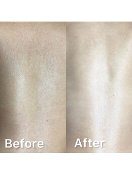 サーティースリー 横浜元町(Thirty3)/【脱毛】Before/After