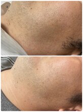 ビューティーホームサロン(Beauty Home Salon)/男性顔脱毛