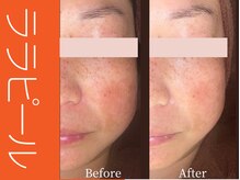 ビューティーリバース 大船店/ララピール50分