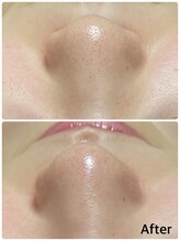 トータルビューティーサロン ヴィヴィエ(ViVier)/スッキリ毛穴ケア