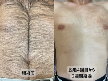 みんなのLED脱毛/2パーツ　胸腹