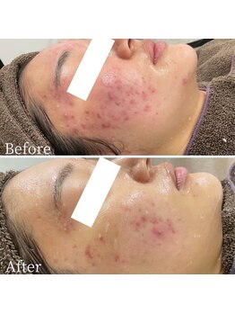 ニキビケア 毛穴研究所 立川店/肌質改善フェイシャルエステ