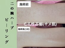 シェリー(Cheri)/【二の腕ハーブピーリング裏面】