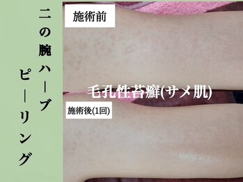 シェリー(Cheri)/【二の腕ハーブピーリング裏面】