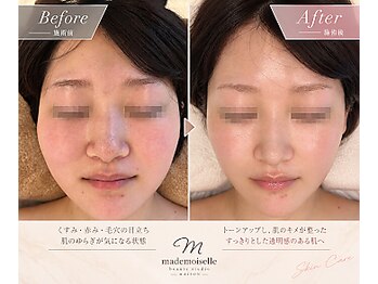 マドモアゼルメゾン 恵比寿(マドモアゼルMaison)の写真/【術後ケア専門】顔の腫れ・むくみ・拘/縮に◎最新インディバでフェイスラインを集中ケア