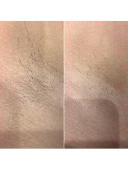 スターポルト(Star-Porte)/ワキ脱毛