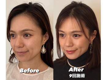 コルミチョン サロン(骨美整 salon)/Before・After 9回施術