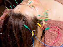 なかま鍼灸整骨院の雰囲気(美容鍼ですっきりリフ。トアップ小顔、むくみ対策【美容鍼灸】)