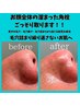 全顔ハイドラ毛穴洗浄スペシャルフルコース￥16500→￥9900/ドライヘッド付