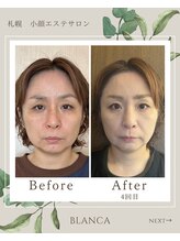 ブランカ(BLANCA)/小顔セラピアビフォーアフター