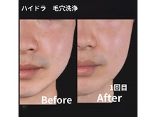 メンズフェイシャルエステ★毛穴汚れ，皮脂除去