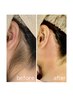 うなじ×もみあげダブル脱毛【WAX×最新光脱毛+炭酸美容液塗布】￥8000