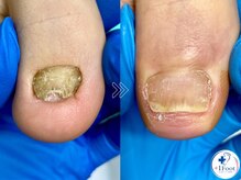 プラスワンフット 本厚木(+1 Foot)/変形・肥厚した爪を正常な爪へ