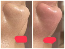 ビューティーホームサロン(Beauty Home Salon)/毛穴エクストラクション