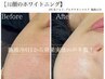 【メラニン生成抑制し美白肌へ】1回施術で美白肌を効果実感多数♪