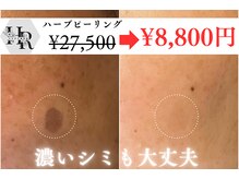 ハーブピーリング（はくりあり/なし）で透明感ある輝く素肌へ