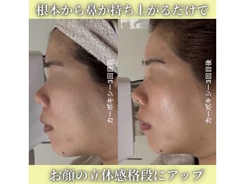 ハニエル(Haniel)/カーボキシー症例