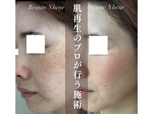 ボーテヌール(Beaute Nheur)/肌プログラムPro