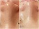 ルリエ(Relier)の写真/黒ずみ・詰まり毛穴をすっきり。なめらかなツルツル肌へ