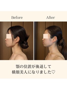 ルマ(Rumah)/小顔施術5回施術後の結果♪