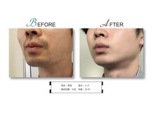 ベルカーラ(Belcarra)の雰囲気（ヴィクトリア脱毛で本気の脱毛！効果に感動連発！8回照射後↑）