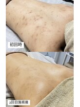 クレヴィー(Creviy)/背中ハーブピーリング