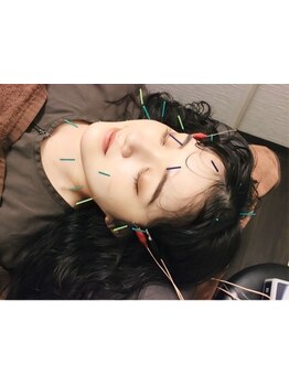 鍼灸施術を受けたい