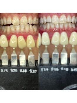 トウキョースワーズ 渋谷店(TOKYO SWRS)/#ホワイトニング #渋谷 #池袋