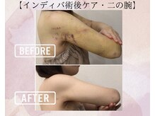 オキシー グレイス 小倉店(OXY Grace)/【インディバ術後ケア・二の腕】