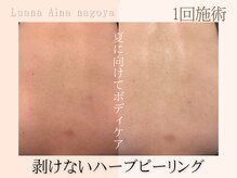 ノイエ(NOIE)/背中ハーブピーリング