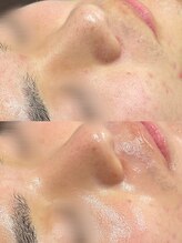 チェルト 鈴鹿店(CERTO)/毛穴の黒ずみにも◎