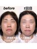 【あと6名】幹細胞美容鍼モニター募集！たるみ・しわケアに（40代以降の方）