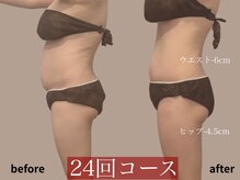 モア 星ヶ丘店(MORE)/痩身ビフォーアフター