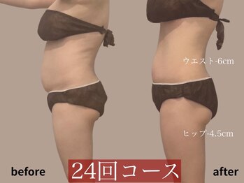 モア 星ヶ丘店(MORE)/痩身ビフォーアフター