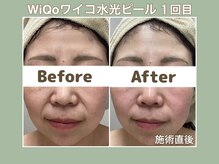 プティ カシェット 伊丹店(petit cachette)/ワイコwiqoビフォー・アフター3