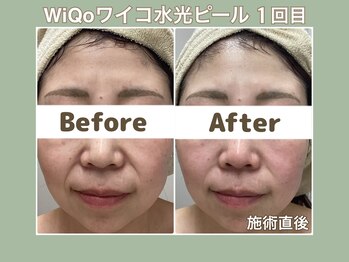 プティ カシェット 伊丹店(petit cachette)/ワイコwiqoビフォー・アフター3