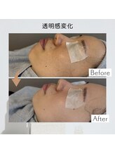 リアン(Lien)/【症例】毛穴ケア×美容液導入