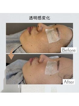 リアン(Lien)/【症例】毛穴ケア×美容液導入