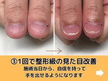 エルナ/１回で大きな見た目改善！