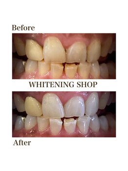 ホワイトニングショップ 高岡店/beforeafter