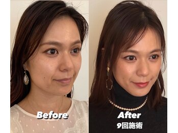コルミチョン サロン(骨美整 salon)/Before・After 9回施術