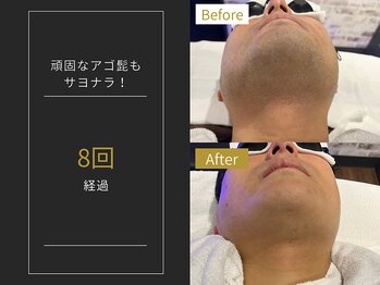 ステイゴールド 新百合ヶ丘(STAY GOLD)/おヒゲ脱毛の経過☆