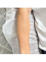 カルム(calm.)/メンズシュガーリング脱毛後